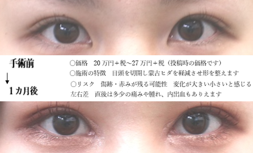 目頭の世界 ヒダをなくす強めの変化の例です 目の隠れた部分をどこまで出すか どこまで変化させるかの調整は可能です 自分自身の目でできることと理想を照らし合わせながら考えていくこととなります 目頭切開 T Co Hh8s033qax Twitter 目頭の世界 ヒダをなくす強めの変化の例です 目の隠れた部分をどこまで出すか どこまで変化させるかの調整は可能です 自分自身の目でできることと理想を照らし合わせながら考えていくこととなります 目頭切開 T Co Hh8s033qax Twitter