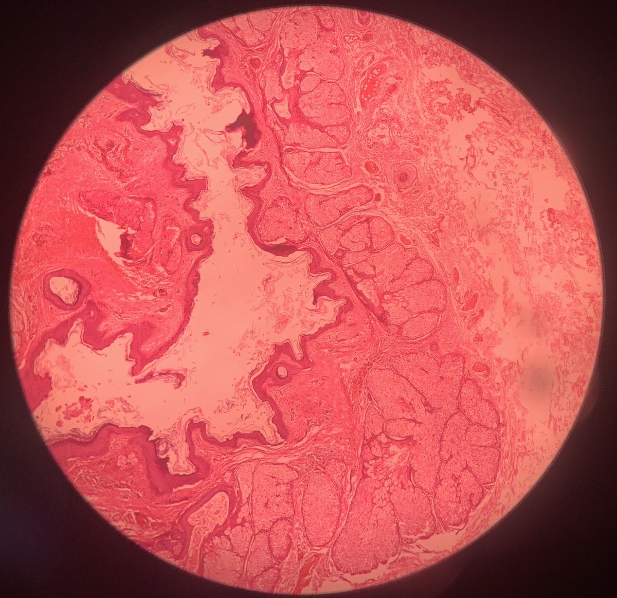 MehtaSameera's tweet image. Dermoid Cyst! #Twitterhomework #Pathology #LoveforPath #Path2Path #PathTwitter