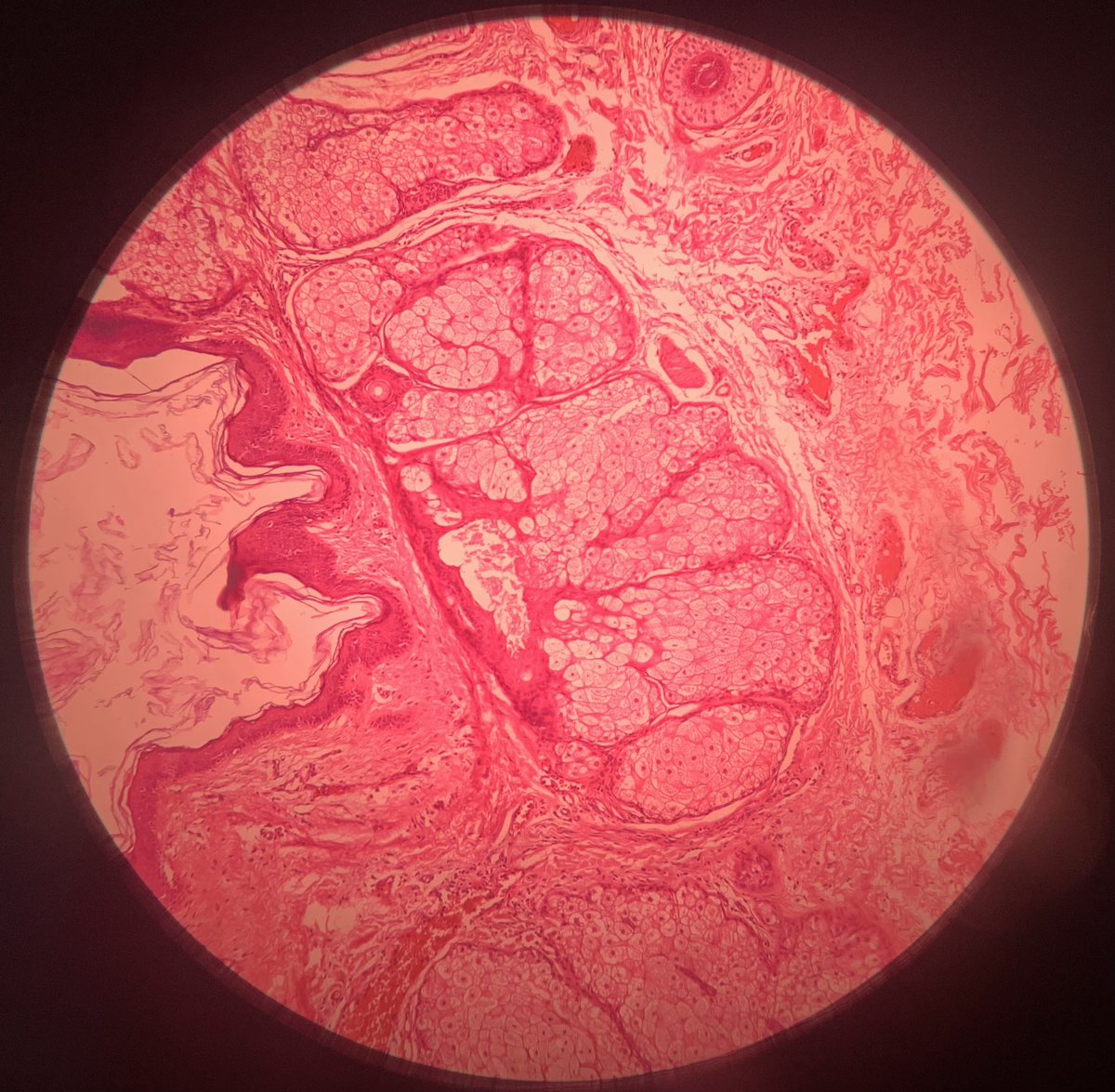 MehtaSameera's tweet image. Dermoid Cyst! #Twitterhomework #Pathology #LoveforPath #Path2Path #PathTwitter
