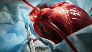 harmonized_in's tweet image. #Organtransplantation is a medical procedure in which an organ is removed from one body and placed in the body of a recipient, to replace a damaged organ. The donor and recipient may be at the same location, or organs may be transported from a donor site to another location.