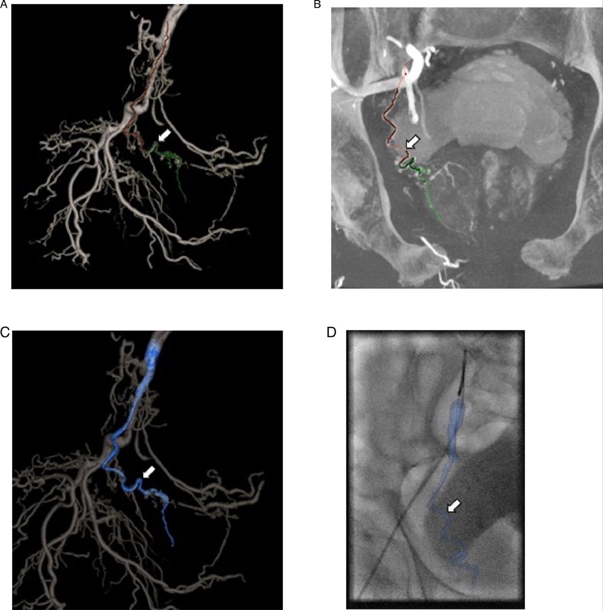 Seminars in Roentgenology (@seminarroentgen) on Twitter photo Prostate artery embolization provides a minimally invasive treatment option for patients with benign prostate enlargement leading to lower urinary tract symptoms. Learn about relevant anatomy and advanced imaging
bit.ly/3nJxL9N
<a href="/wadhwa_rad/">Vibhor Wadhwa MD EBIR</a> <a href="/TimMcClureMD/">Tim McClure</a> <a href="/WeillCornell_IR/">Weill Cornell Medicine Interventional Radiology</a> Prostate artery embolization provides a minimally invasive treatment option for patients with benign prostate enlargement leading to lower urinary tract symptoms. Learn about relevant anatomy and advanced imaging
bit.ly/3nJxL9N
<a href="/wadhwa_rad/">Vibhor Wadhwa MD EBIR</a> <a href="/TimMcClureMD/">Tim McClure</a> <a href="/WeillCornell_IR/">Weill Cornell Medicine Interventional Radiology</a>