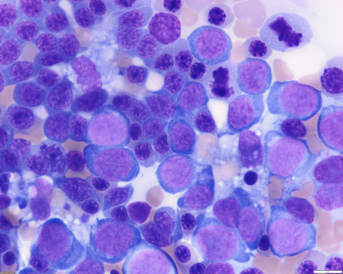 sanamloghavi's tweet photo. The degree of erythroid hyperplasia is unusual for PMF.. remember PMF is an erythroid-depleting disease (text screenshot from WHO 4th ed) https://t.co/5Vb1mds0Ca
