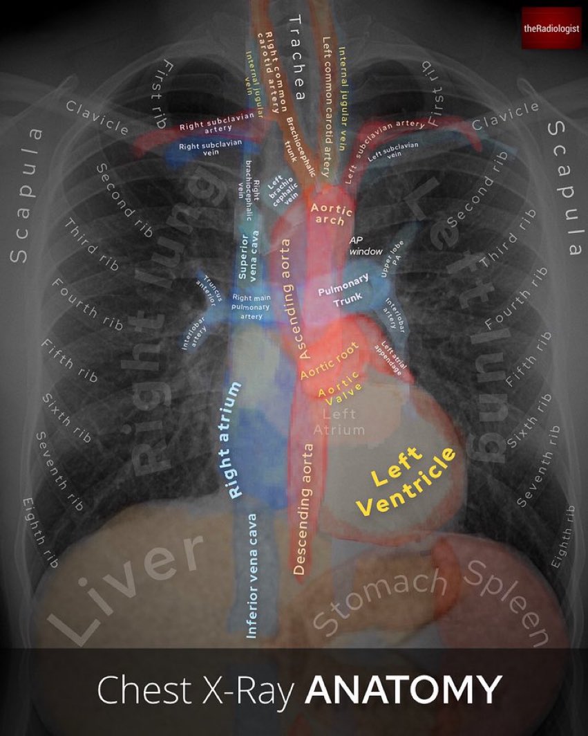 This is the best chest x-ray anatomy guide I’ve ever seen. Via @radiologistpage #MedTwitter