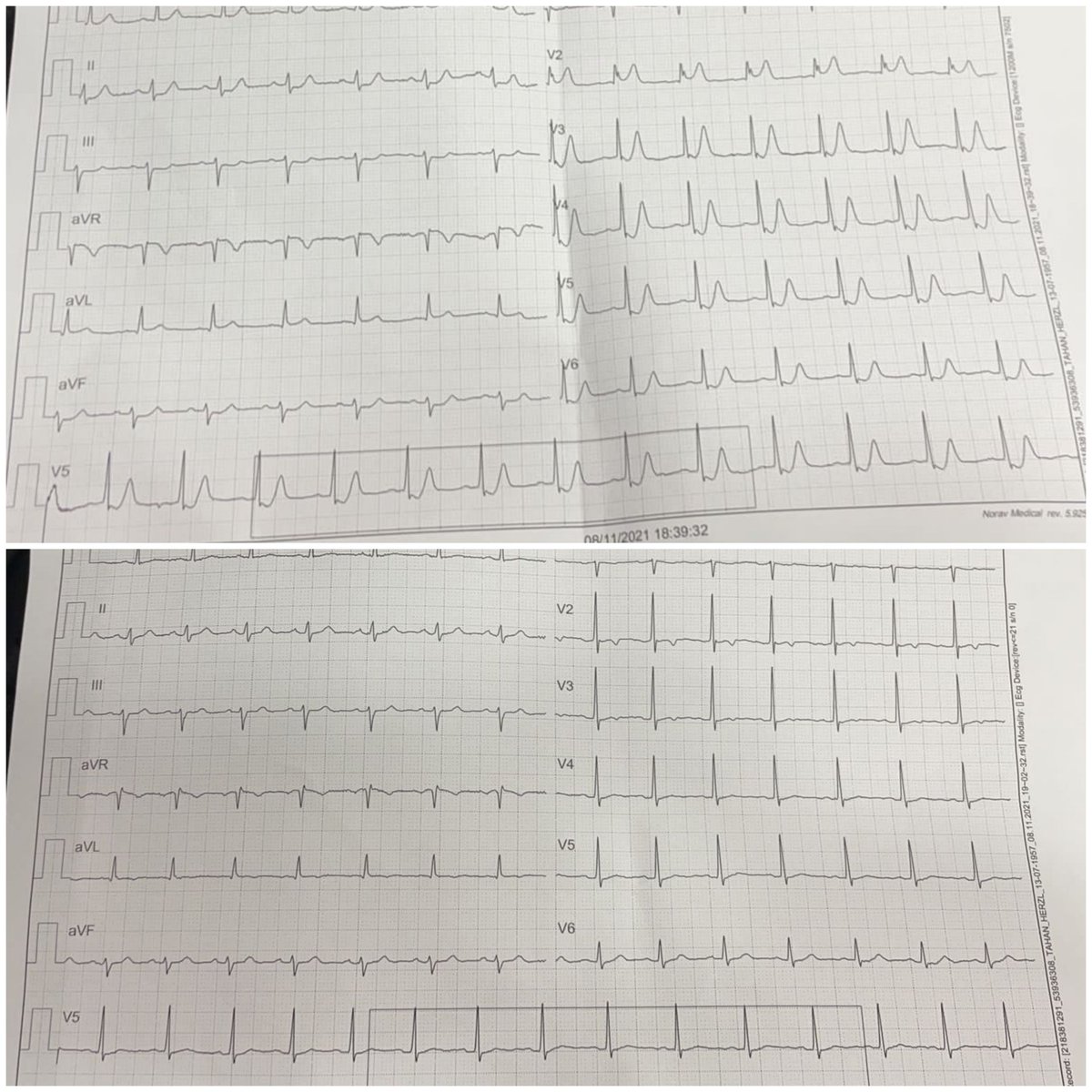 Very early stage of anterior STEMI. ECG done 15 minutes from initiation of chest pain. Fully resolved after chewing 300 mg of aspirin.