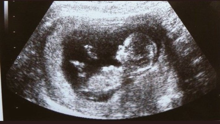 11 недель беременности девочка