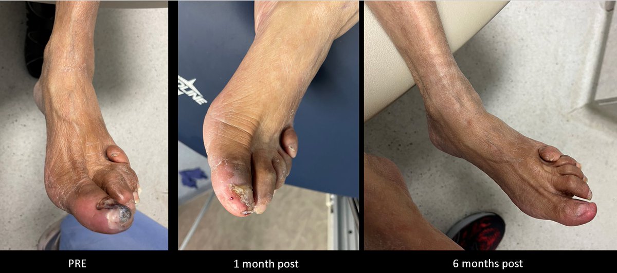 Sabeen Dhand (@sdhandmd) on Twitter photo 94yo hallux ischemia, failed retro AT recan, sent for BKA 😬➡️ direct peroneal stick FTW! >6 months w/ 😁feet & patient
<a href="/kmadass/">Kumar Madassery</a> <a href="/LessneVIR/">Mark Lessne, MD</a> <a href="/Watts_IR/">Mike Watts</a> <a href="/omarsaleh66/">Omar Solana MD NFT</a> @VenuVadlamudiMD <a href="/keithppereira/">Keith Pereira MD, #VIrad</a> <a href="/AgnesSolberg/">Agnieszka Solberg MD</a> <a href="/dandu_n/">Zola N'Dandu, MD</a> <a href="/t_intheleadcoat/">Venkat Tummala MD</a> <a href="/AmputationSuck/">👊🏾👍🏾BT Fisher Sr., MD</a> <a href="/JayMathewsMD/">Jay Mathews MD, MS, FACC, FSCAI</a> <a href="/YsaAugust/">August Ysa</a> 94yo hallux ischemia, failed retro AT recan, sent for BKA 😬➡️ direct peroneal stick FTW! >6 months w/ 😁feet & patient
<a href="/kmadass/">Kumar Madassery</a> <a href="/LessneVIR/">Mark Lessne, MD</a> <a href="/Watts_IR/">Mike Watts</a> <a href="/omarsaleh66/">Omar Solana MD NFT</a> @VenuVadlamudiMD <a href="/keithppereira/">Keith Pereira MD, #VIrad</a> <a href="/AgnesSolberg/">Agnieszka Solberg MD</a> <a href="/dandu_n/">Zola N'Dandu, MD</a> <a href="/t_intheleadcoat/">Venkat Tummala MD</a> <a href="/AmputationSuck/">👊🏾👍🏾BT Fisher Sr., MD</a> <a href="/JayMathewsMD/">Jay Mathews MD, MS, FACC, FSCAI</a> <a href="/YsaAugust/">August Ysa</a>