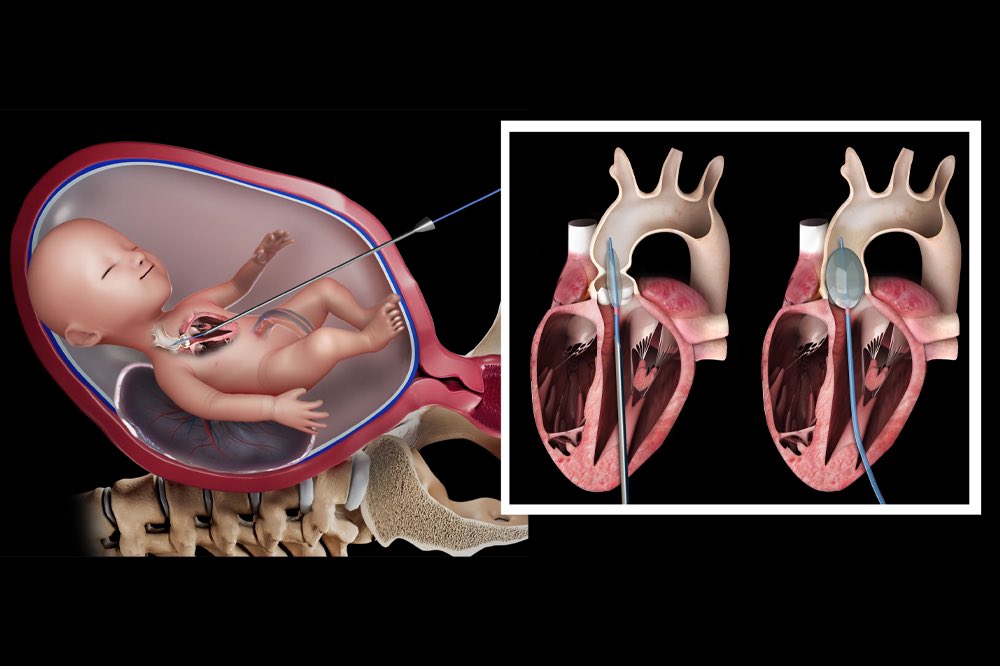 saia_francesco's tweet photo. Fetal balloon aortic valvuloplasty in utero at the University Hospital of Bologna, Policlinico St Orsola, by the Pediatric Interventional Cardiology team led by Andrea Donti with @GEgidyAssenza and Elisabetta Mariucci 
The newborn is now 1 month old, growing just fine 👍👏😀🔝 https://t.co/qSm33HwhiF