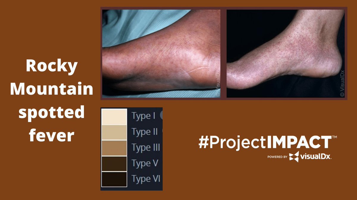 ProjectIMPACT__'s tweet photo. Skin pigmentation is not binary as light and dark skin but happens on a sliding scale. The #FitzpatrickScale is helpful for creating patient and case specific diagnoses.

#SkinPigmentation #LightSkin #DarkSkin #PatientDiagnosis #CaseSpecificDiagnosis #RockyMountainSpottedFever https://t.co/HaeJT05DY6