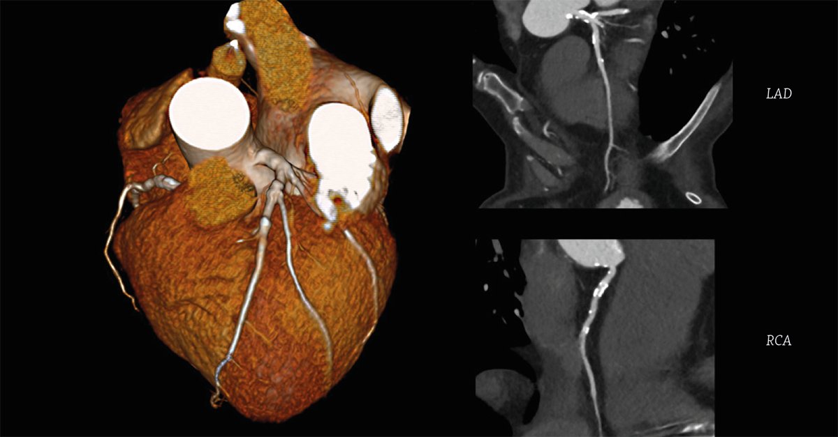 CanonMedicalANZ's tweet image. Find out how the #DeepLearningReconstruction #AI technology on Canon Medical's Aquilion ONE / PRISM Edition has been a game changer for #lowdose #cardiac CTA examinations at the radiology department of Charité in Europe. Read the article.
bit.ly/3bPIQk9