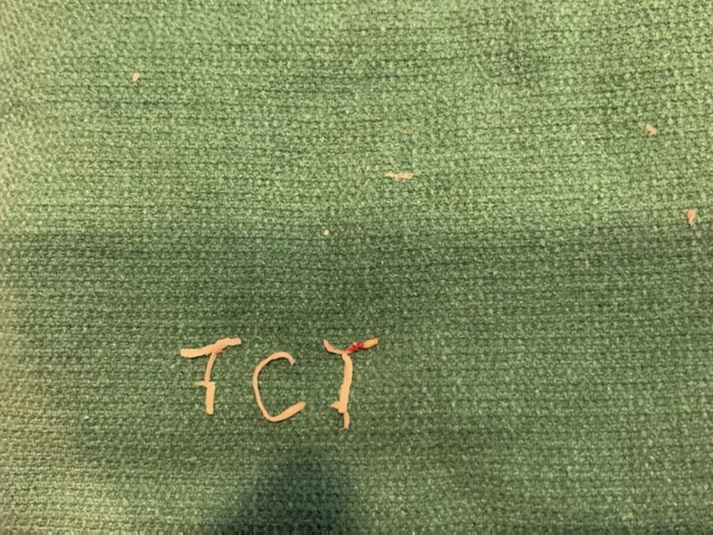 ReVascMed (@revascmed) on Twitter photo The first case to kick off the week reflecting lessons learned at the recent interventional cardiology meeting #TCT2021 in Orlando! #PlaqueArt #PennsyInterventions <a href="/crfheart/">Cardiovascular Research Foundation</a> <a href="/GPAngioClub/">Phila Angio Club</a> <a href="/ACVCPhila/">Academy for CardioVascular Collaboration</a> <a href="/jcgeorgemd/">Jon George</a> <a href="/PennCVFellows/">Penn Cardiology Fellows</a> @AvingerInc The first case to kick off the week reflecting lessons learned at the recent interventional cardiology meeting #TCT2021 in Orlando! #PlaqueArt #PennsyInterventions <a href="/crfheart/">Cardiovascular Research Foundation</a> <a href="/GPAngioClub/">Phila Angio Club</a> <a href="/ACVCPhila/">Academy for CardioVascular Collaboration</a> <a href="/jcgeorgemd/">Jon George</a> <a href="/PennCVFellows/">Penn Cardiology Fellows</a> @AvingerInc