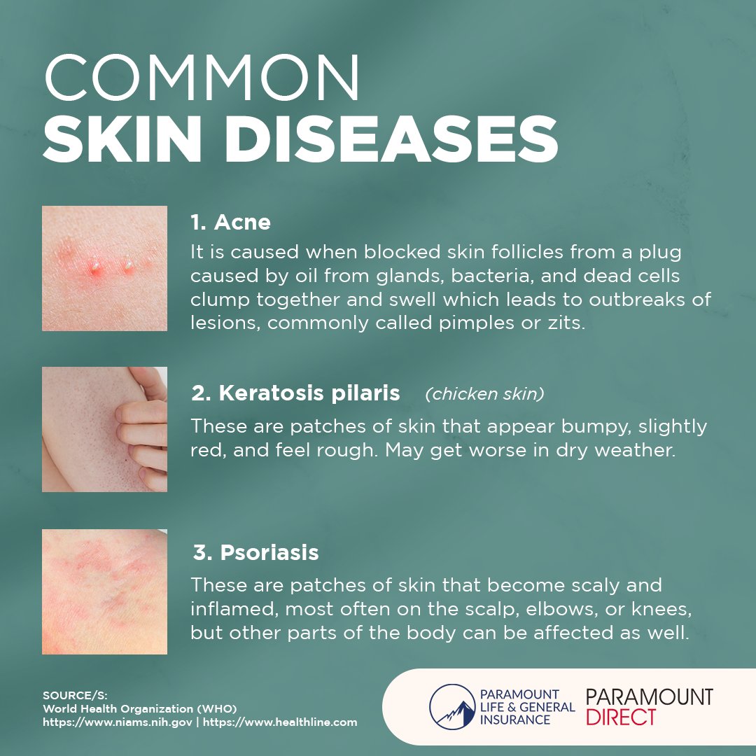 plgic1950's tweet photo. Mahalagang alam natin ang importansya ng self-examination, sapat na skin care, at maagang pagkonsulta sa mga dermatologists upang lubos na maalagaan ang ating balat. #itstimetoredirect #paramountinsurance #paramountdirect #NationalSkinDiseaseDetectionandPreventionWeek https://t.co/iOHEaX9EqR
