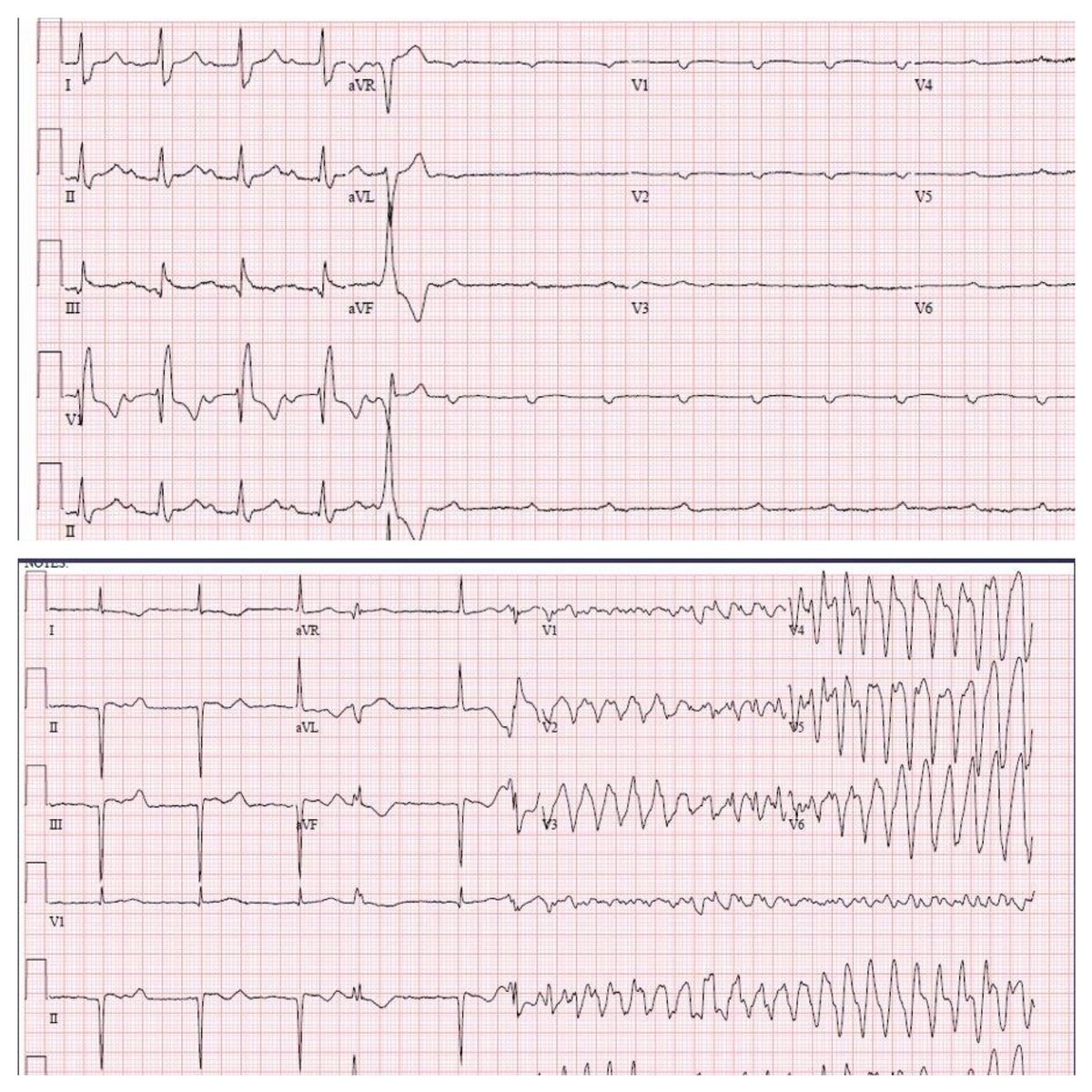 EhdaieMd's tweet image. Artists and photographers showcase their best work….maybe EKG techs should do the same #cardiotwitter #TimingIsEverything