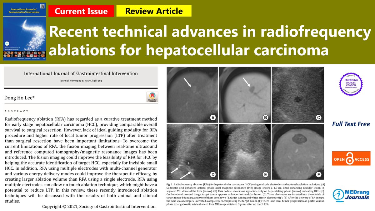IJGII_SGI's tweet photo. Recent technical advances in radiofrequency ablations for hepatocellular carcinoma
๐https://t.co/7tPzbkXot9
Int J Gastrointest Interv 2021; 10(4) Dong Ho Lee
#Hepatocellular_carcinoma #Multimodal_imaging #Radiofrequency_ablation https://t.co/R1hVGjb18N