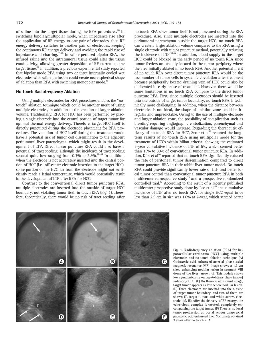 IJGII_SGI's tweet photo. Open Access ๐https://t.co/7tPzbkXot9
In this review, these recently introduced ablation techniques will be discussed with the results of both animal and clinical studies.
#Hepatocellular_carcinoma #Multimodal_imaging #Radiofrequency_ablation https://t.co/5YbSGQYLoG