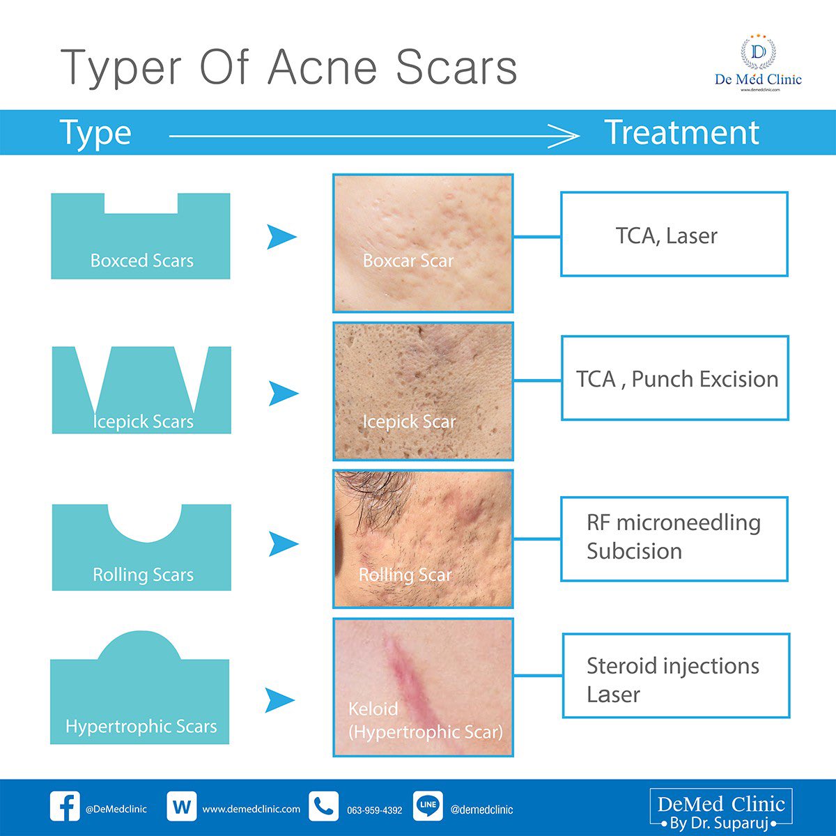 DrSuparuj's tweet photo. 📍ดูแลแผลเป็นจากสิว Acne Scar ได้อย่างไรบ้าง 👨‍⚕️

#หมอรุจชวนคุย
#รักษาหลุมสิว #หลุมสิว #แผลเป็น #รอยสิว #Picosecondlaser #ตัดพังผืด #Subcision #TCACROSS ➡️ https://t.co/2CkDLdEuz5 https://t.co/X76PLTiGxf