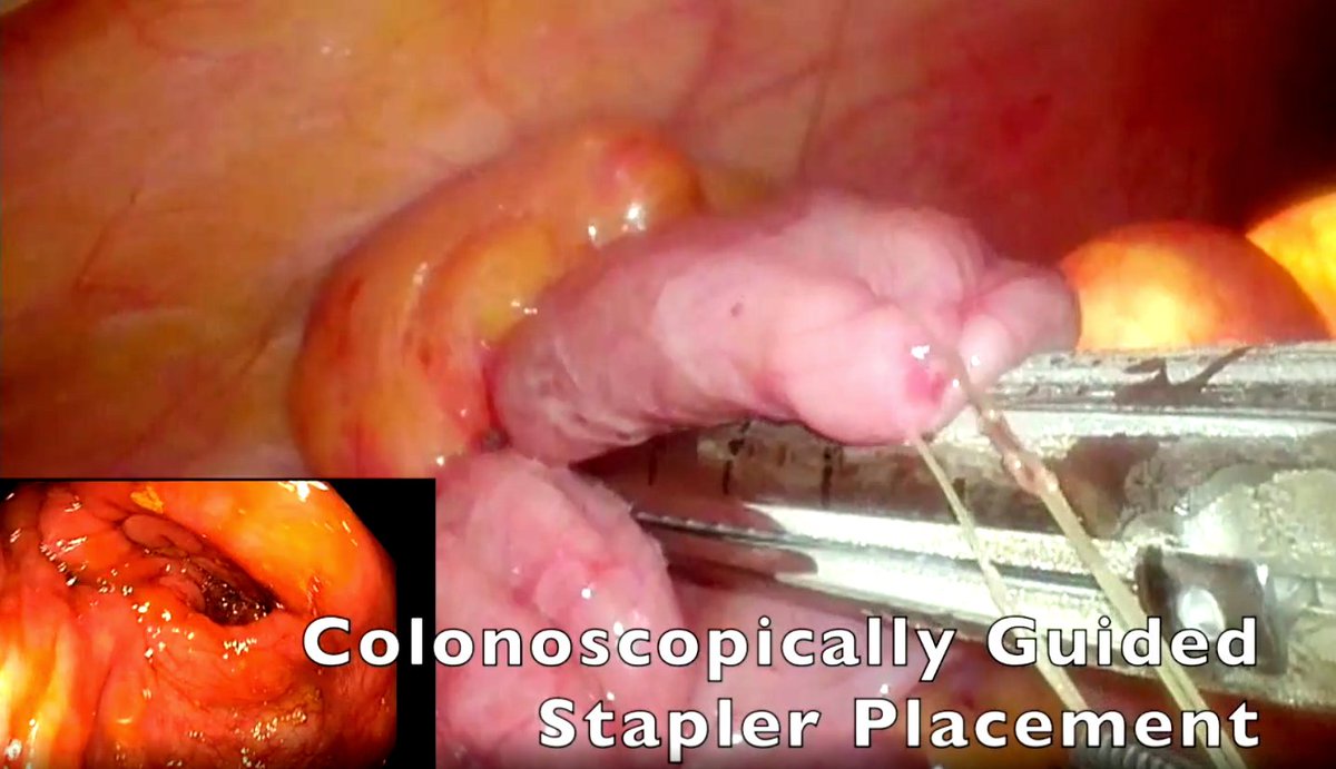 ERIK NOREN (@eriknoren_md) on Twitter photo New <a href="/DCRjournal/">DCRjournal</a> Dynamic Article:
"Full-Thickness Laparoendoscopic Excision for Management of Complex Colon Polyps"
tinyurl.com/2xw645vv
<a href="/CRSofUSC/">USC Colorectal Surgery - Keck School of Medicine</a> <a href="/USCGenSurg/">USC | LAG Surgery</a> New <a href="/DCRjournal/">DCRjournal</a> Dynamic Article:
"Full-Thickness Laparoendoscopic Excision for Management of Complex Colon Polyps"
tinyurl.com/2xw645vv
<a href="/CRSofUSC/">USC Colorectal Surgery - Keck School of Medicine</a> <a href="/USCGenSurg/">USC | LAG Surgery</a>