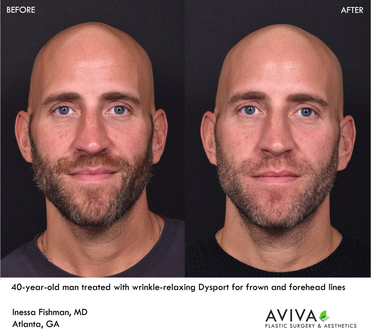 AvivaPSA's tweet photo. Muscle-relaxing #Botox, #Dysport, and #Jeuveau are powerful wrinkle erasers, and are commonly used to treat frown and forehead lines.  Botox and related medications are usually most effective for dynamic lines--or lines which appear with expression. https://t.co/zSwtYDtff6