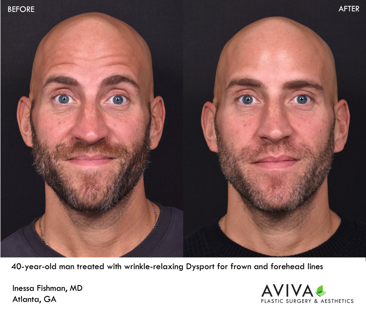 AvivaPSA's tweet photo. Muscle-relaxing #Botox, #Dysport, and #Jeuveau are powerful wrinkle erasers, and are commonly used to treat frown and forehead lines.  Botox and related medications are usually most effective for dynamic lines--or lines which appear with expression. https://t.co/zSwtYDtff6