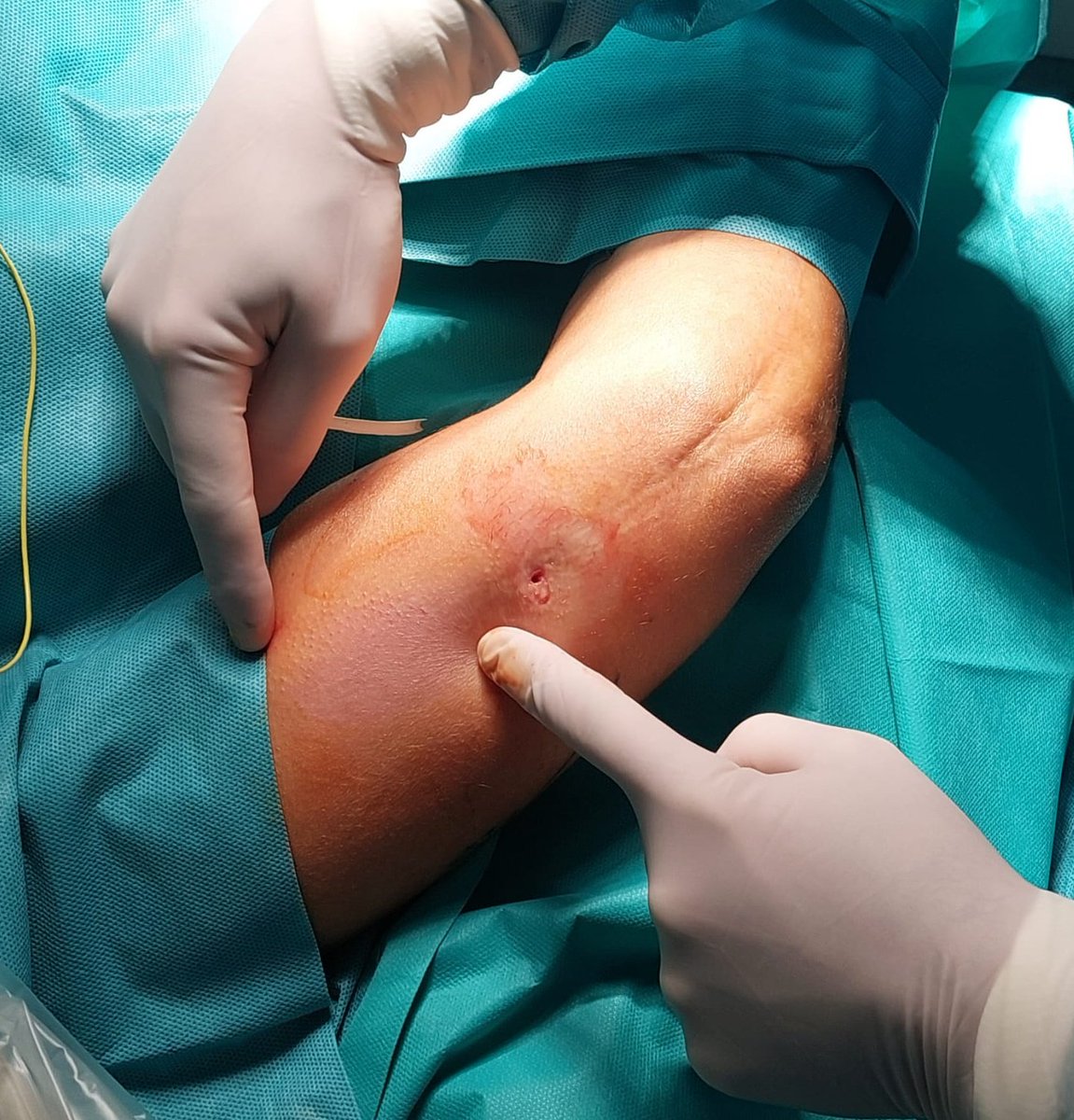 drmoyvcm's tweet photo. 1er electrodo de nervio periférico StimRouter en #HRJC, Nervio cubital a nivel de brazo x dolor neurópatico en codo y antebrazo. Mejor compañía.... IMPOSIBLE¡¡¡. #PRIM #StimRouter #hospitalreyjuancarlos https://t.co/bJX6U5MAjb