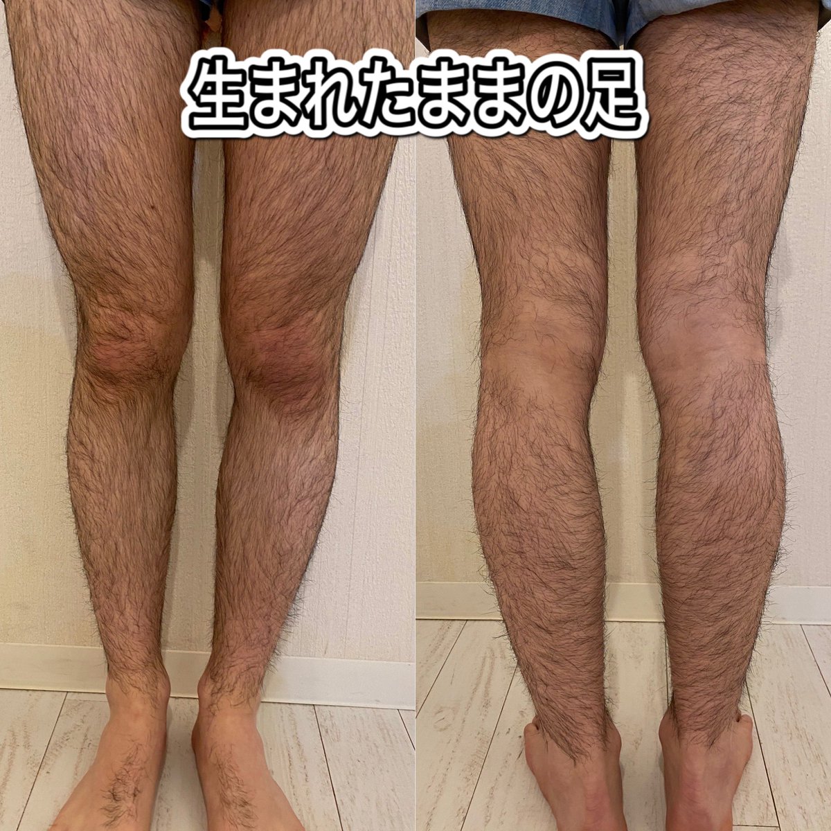 fascinate_ryu's tweet photo. 6回目施術後、1ヶ月放置してもあまり生えてきてません。脱毛途中でも生えるスピードが遅くなるので、快適な状態で過ごせます！まだ、細い毛が生えてくることはありますが、メンテナンス程度で脱毛していくことでその間隔も開いていきます。
両足(足の甲なし)  1回
通常料金 10000円　sns割 8000円 https://t.co/Uj8NmX0uj1