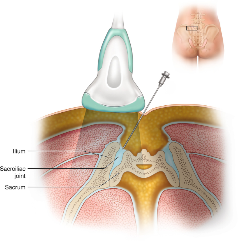 Pain_Spec_Aus's tweet photo. Our pain specialists were discussing safest ways of performing a sacroiliac joint block for some forms of lower back/buttock pain. Some now consider ultrasound to be the safest.
Here is some further reading on this technique
https://t.co/BebhUU3P5W
#painblocks #backpain https://t.co/Xc0q9be7So