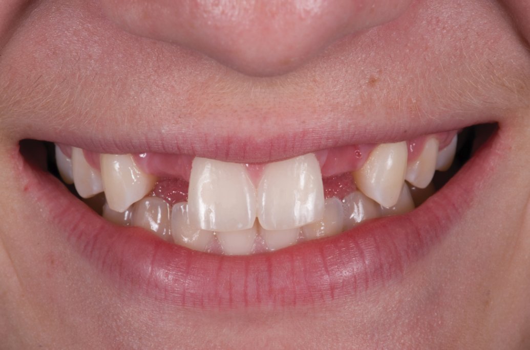 InDentalTech's tweet photo. Read “Metal vs Zirconia Resin-Bonded Bridges” by Tal Morr, DMD, take a short quiz, and earn 1 CE credit! https://t.co/QrHHW9sXDM #ContinueYourEducation https://t.co/vTAaXcPrz0