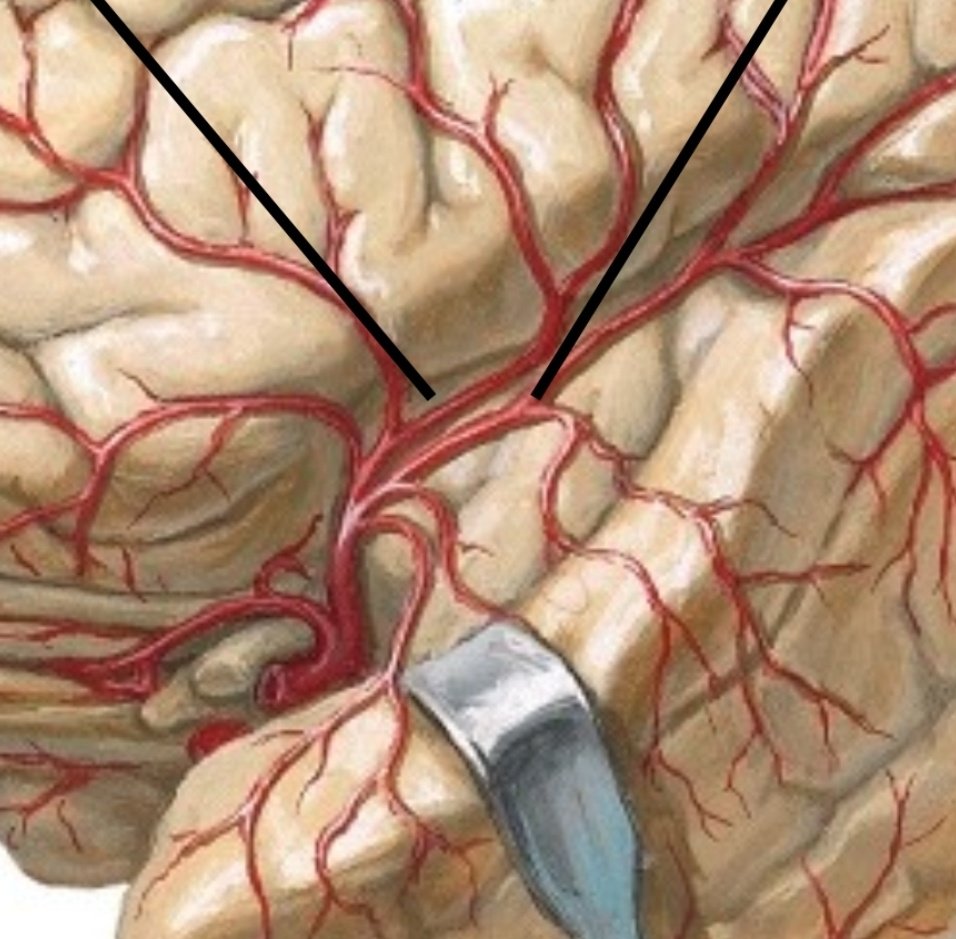 PeteFiesterMD's tweet photo. Review old cases "backwards" #radres to 📈 reading 🧠 CTA exams & learn vascular territories ⬇️
✅ MRI = R. operculum #stroke
✅ CTA = M2 MCA sup. division branch occlusion
#neurorad #radiology #neurores #neurology https://t.co/wZXjX43uno