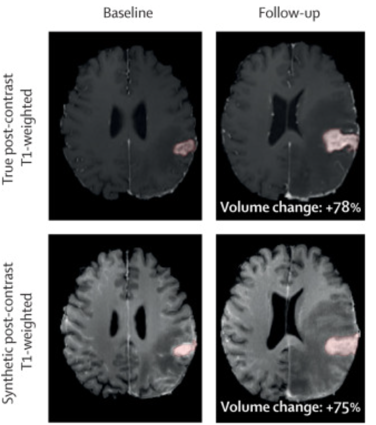 thmonk_pf's tweet photo. 畳込深層ニューラルネットワーク(dCNN)を用いた合成Gd造影T1強調MRI
dCNNを用いて、非造影頭部MRIイメージからGd造影MRIイメージを生成する
Open Access
#CEMRI
#dCNN
#papers
👇論文はこちら
https://t.co/61RrCIkciY https://t.co/60ltknW6cV