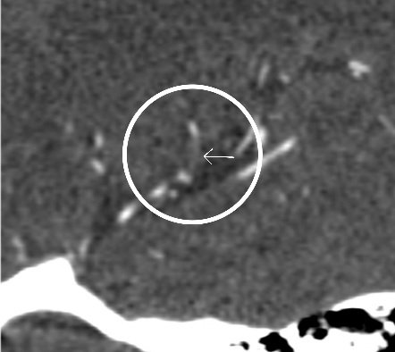 PeteFiesterMD's tweet photo. Review old cases "backwards" #radres to 📈 reading 🧠 CTA exams & learn vascular territories ⬇️
✅ MRI = R. operculum #stroke
✅ CTA = M2 MCA sup. division branch occlusion
#neurorad #radiology #neurores #neurology https://t.co/wZXjX43uno