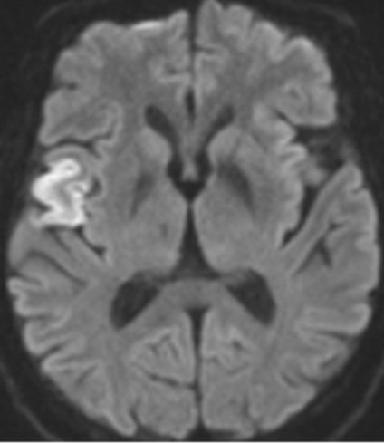 PeteFiesterMD's tweet photo. Review old cases "backwards" #radres to 📈 reading 🧠 CTA exams & learn vascular territories ⬇️
✅ MRI = R. operculum #stroke
✅ CTA = M2 MCA sup. division branch occlusion
#neurorad #radiology #neurores #neurology https://t.co/wZXjX43uno