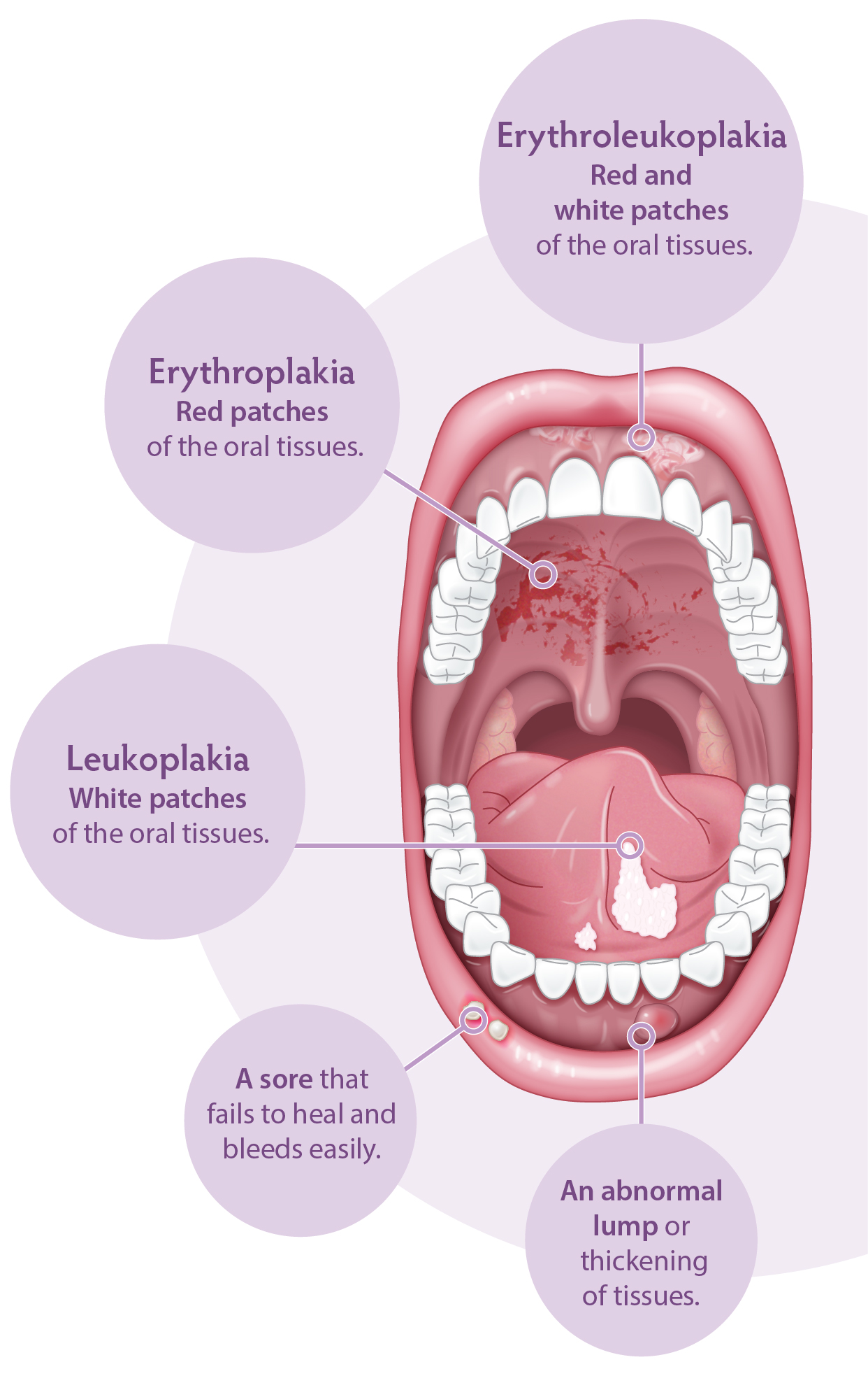 Oral Cancer White Spots On Gums Unbeatable Offers Www Bharatagritech Oral Cancer White Spots On Gums Unbeatable Offers Www Bharatagritech