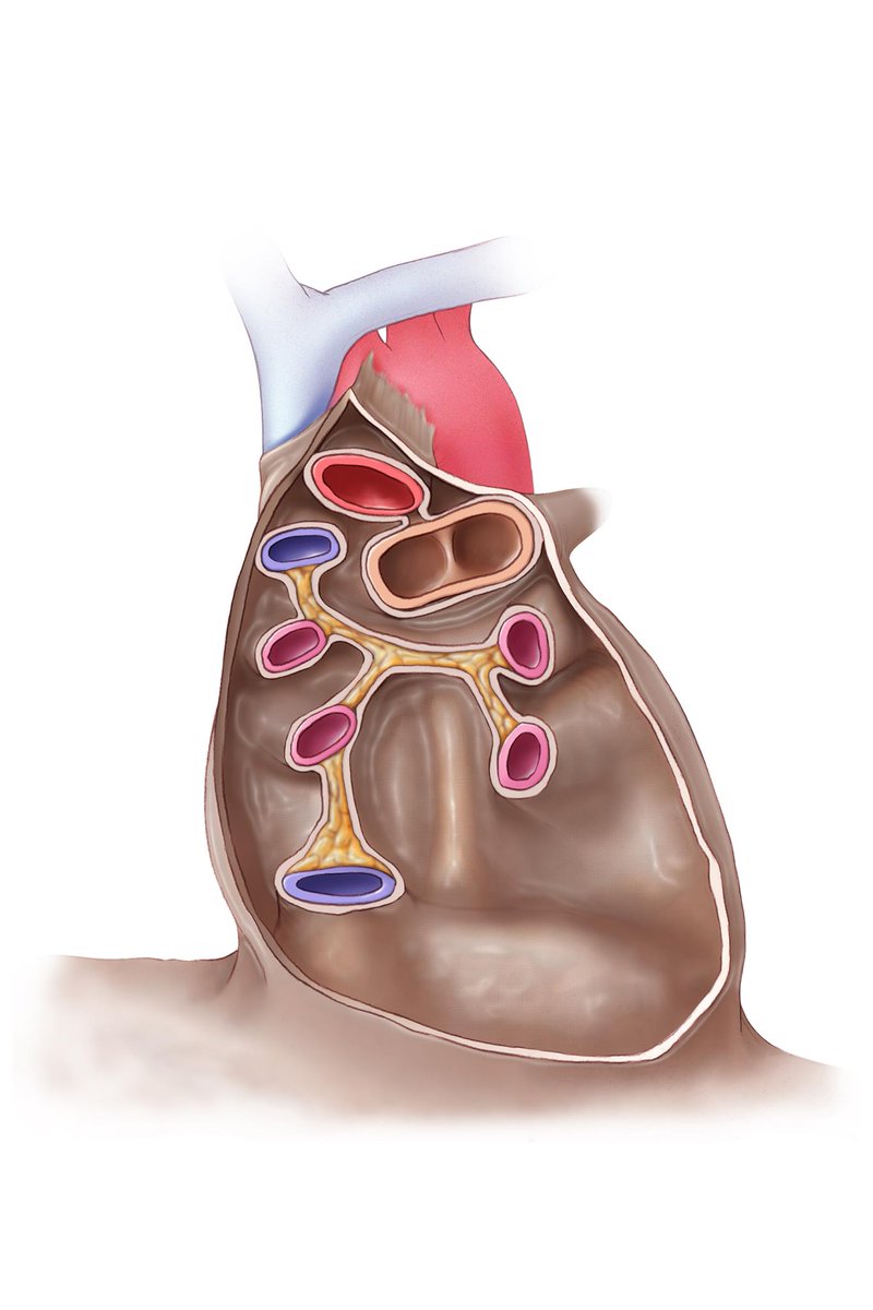 CT Pericardium