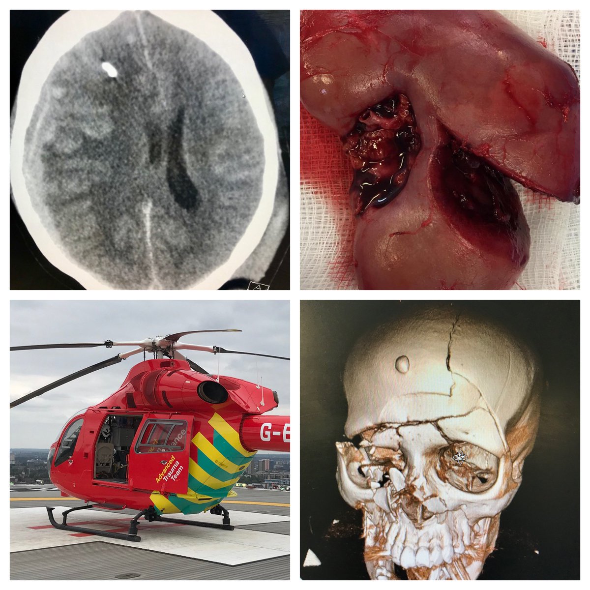 KateHancorn's tweet photo. Applications open for post CCT advanced training fellowships in Major Trauma. Due to commence August 2022: multidisciplinary fellowship provides consolidated trauma experience for successful candidates wishing to pursue a trauma career. Highly recommended! https://t.co/LD2BCAsilC https://t.co/Lwf01lYIuj