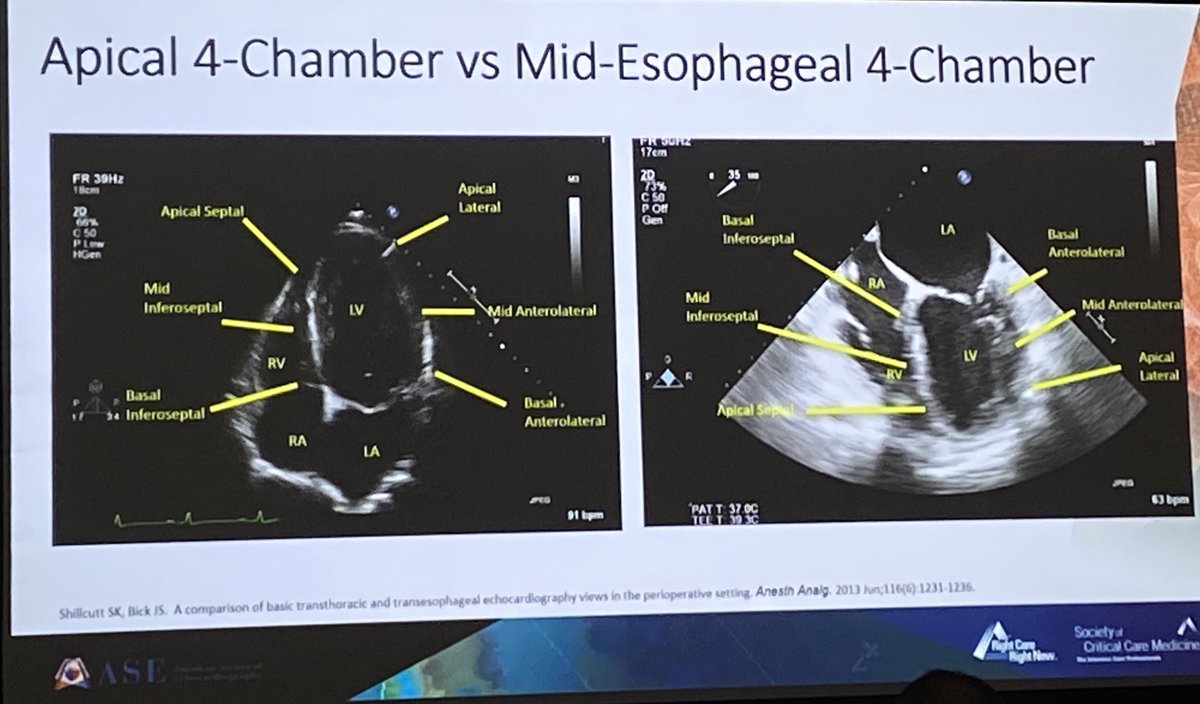 VLSorrellImages's tweet photo. Outstanding overview of TEE for the Intensivist by @Behrens_MD during Day 1 of the #CCExam @ASE360 @SCCM review course!

Ouch- I cringe every time I see that Figure! https://t.co/ogbuDjpcpj