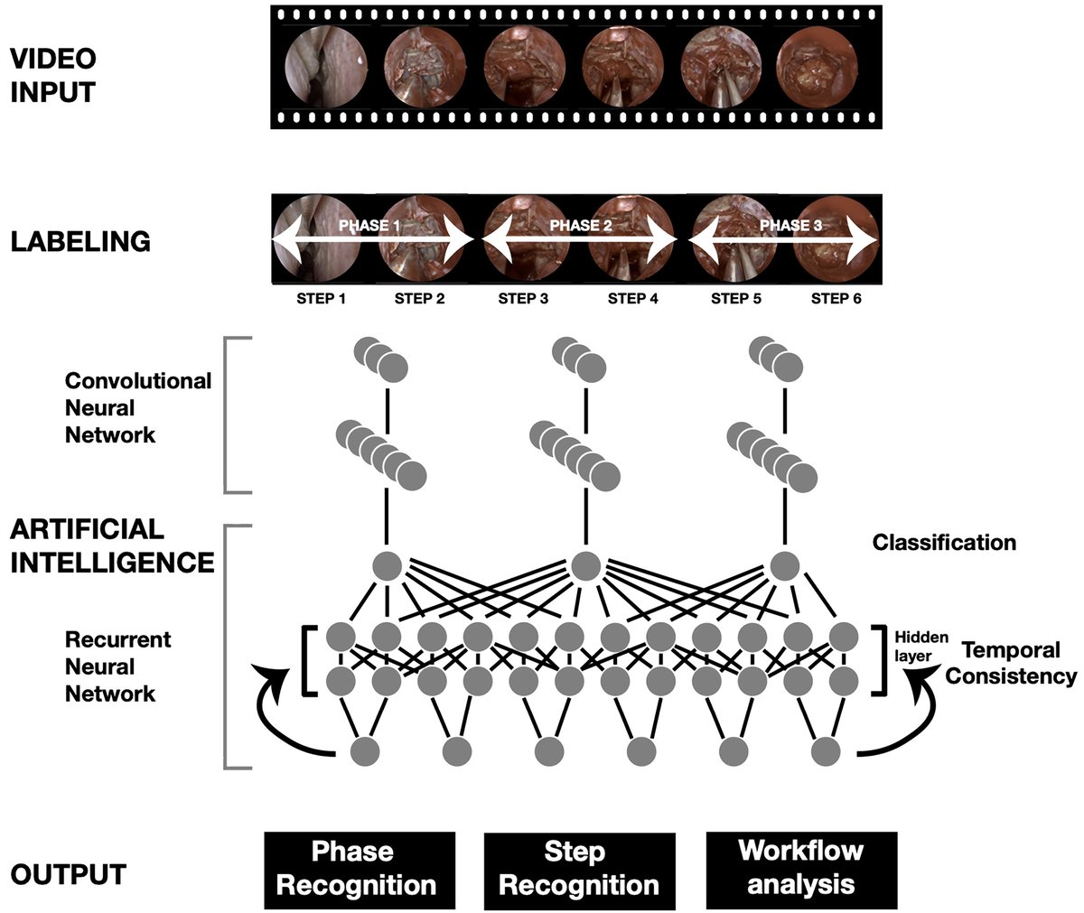 #OnlineFirst: Automated operative workflow analysis of endoscopic pituitary surgery using machine learning: development and preclinical evaluation (IDEAL stage 0) thejns.org/view/journals/…