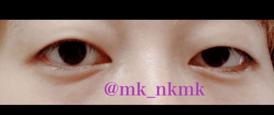 mk_nkmk's tweet photo. 術前
やっぱり左目下垂気味だよね https://t.co/kB5lRNzL5I