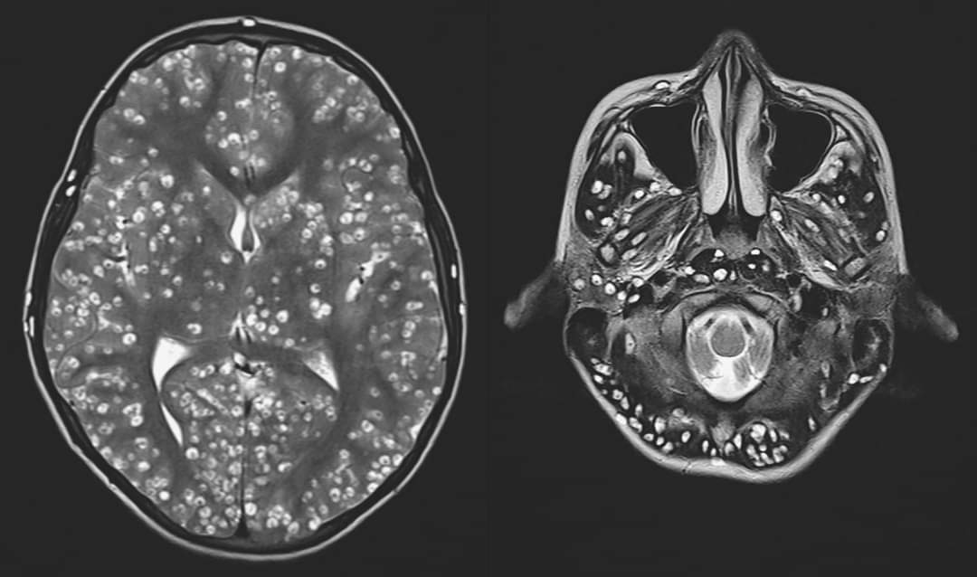 mICROBIOsh's tweet photo. Cisticercosis generalizada.

Un hombre de 18 años acudió al servicio de urgencias con convulsiones tónico-clónicas generalizadas, tenía hinchazón sobre el ojo derecho y sensibilidad en el testículo derecho. https://t.co/IKDxk1lf7X
