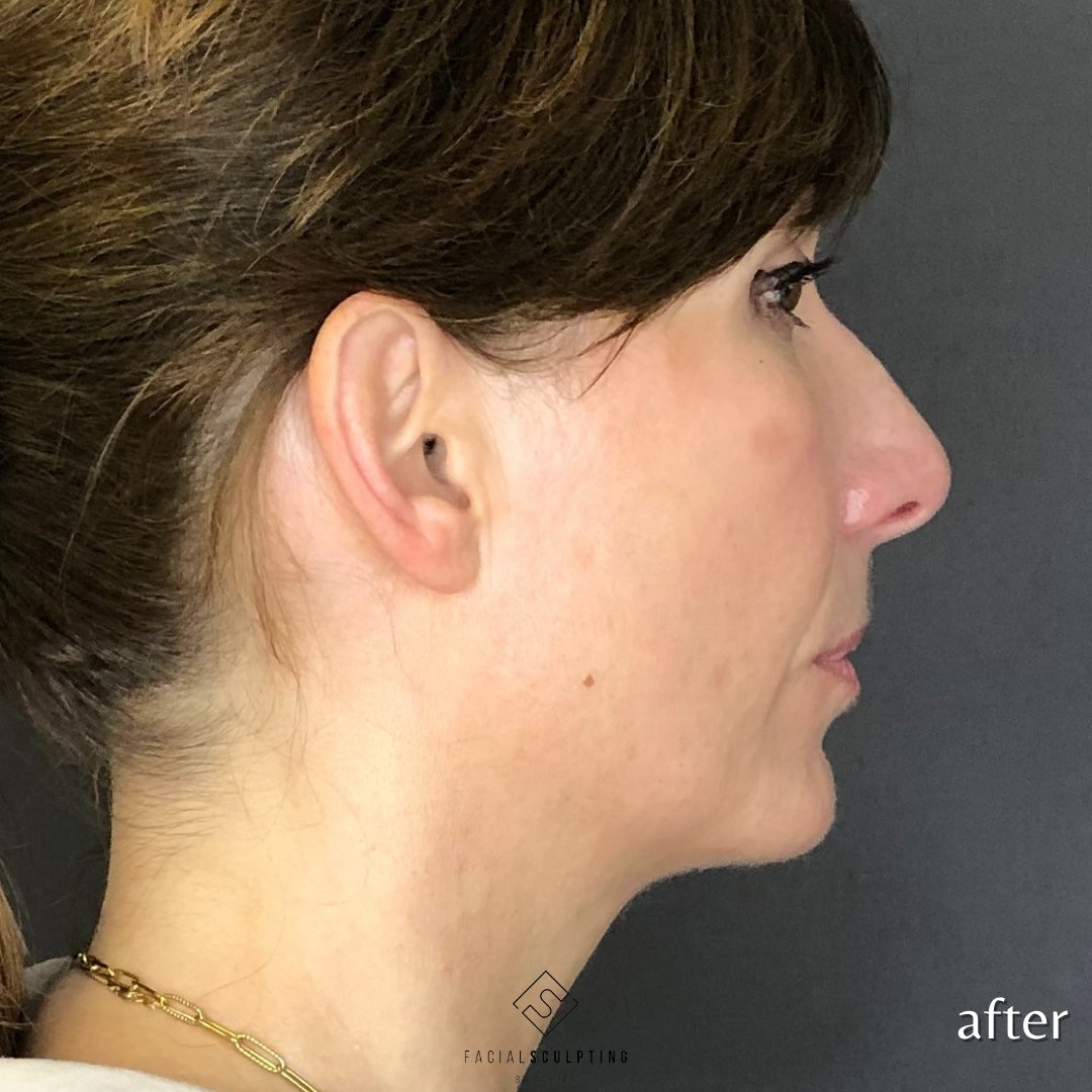 DrNinaBal's tweet photo. The. Best. Treatment. Full stop.
(Ok, maybe not the best-best, but to me, definitely top 3)
Want to know which one it is? Head over to my IG and scroll through today's post...see you there!
@endolift.uk @endolift_official @endolift_usa
#beforeandafter #endolift #facelift https://t.co/IJp3Oiop2Z