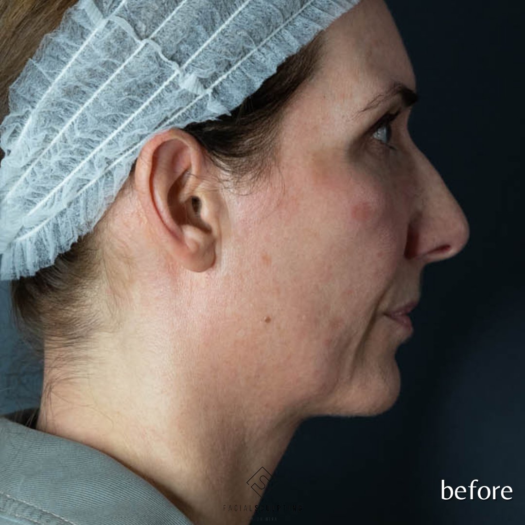DrNinaBal's tweet photo. The. Best. Treatment. Full stop.
(Ok, maybe not the best-best, but to me, definitely top 3)
Want to know which one it is? Head over to my IG and scroll through today's post...see you there!
@endolift.uk @endolift_official @endolift_usa
#beforeandafter #endolift #facelift https://t.co/IJp3Oiop2Z