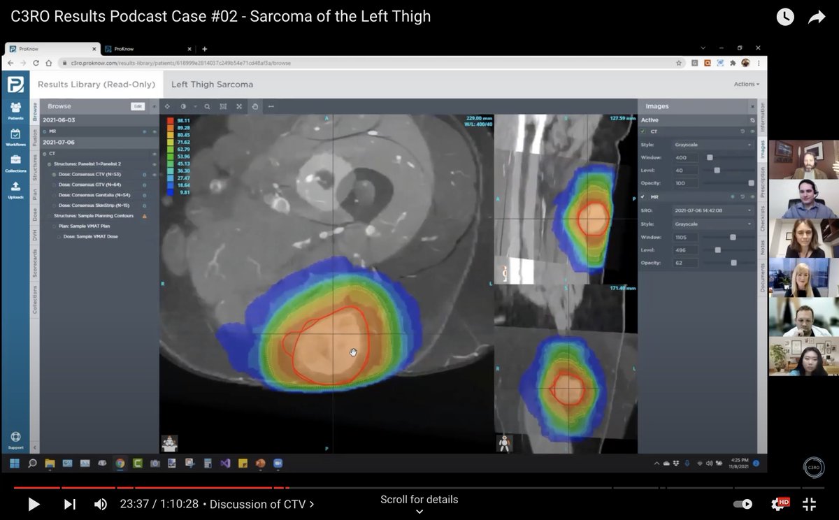 eContourRadOnc's tweet photo. 🔥 off the press: #C3RO's 2nd 🎙️ podcast feat. 🌟 #radonc Dr. @SprakerMDPhD & Dr. @ShaunaRadOnc discussing results of a lower extremity #sarcoma case! #MedEd
Don't miss the hype! ✅ out this video here 👉 https://t.co/nvCdDHo9MQ
🗣️ H&N case coming next❗️ https://t.co/8fj6eKlOZS