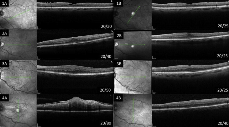 In a OCT analysis of 322 eyes, Stage 4 characteristics, ellipsoid zone disruption and inner microcystoid changes were imaging biomarkers associated with visual acuity outcomes following idiopathic epiretinal membrane surgery. Older patients had worse VA ow.ly/4Bjr50GJhRL