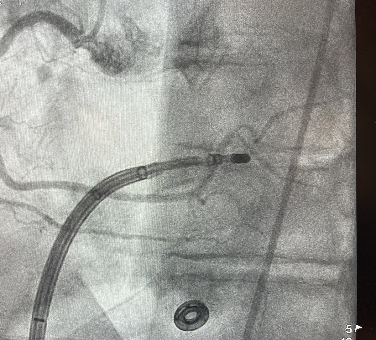 badinmd's tweet photo. 79 yo, PVC 18%, V2 Reverse Break patter, suggestive Crux (MCV basal vs Apical) #EPeeps #epfellows @SreeBillakanty , 20 ms preQrs, 98% pacemap, RCA branches far enough, 20 w, no recurrence up to 45 mins. @OhioHealth Electrophysiology @Jason__Mumford https://t.co/fstAq7DOq3