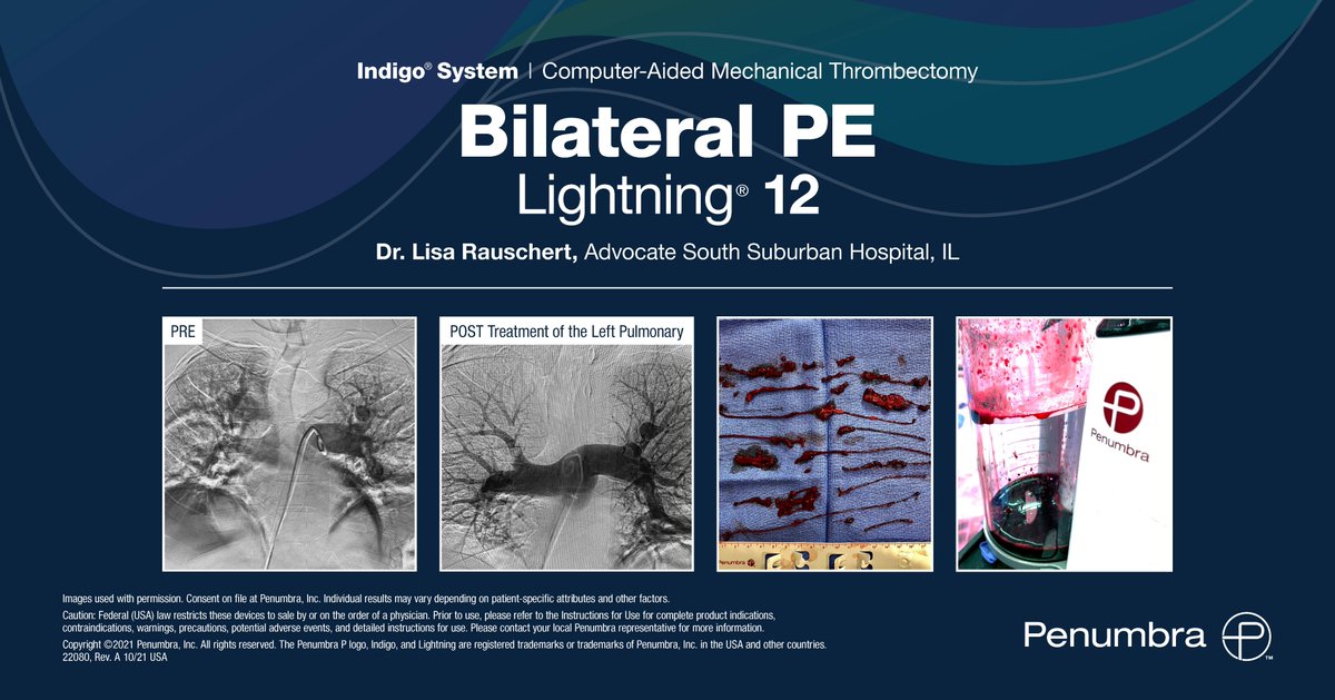 PenVascular's tweet photo. US HCPs: Congratulations Dr. Rauschert for a successful #SingleSession #Lightning12 bilateral PE case! #LeadWithLightning Rx only. For indications contraindications, warnings, precautions & potential adverse events: https://t.co/wrIewh9jVv Clinical results may vary https://t.co/zcJlGNpct6