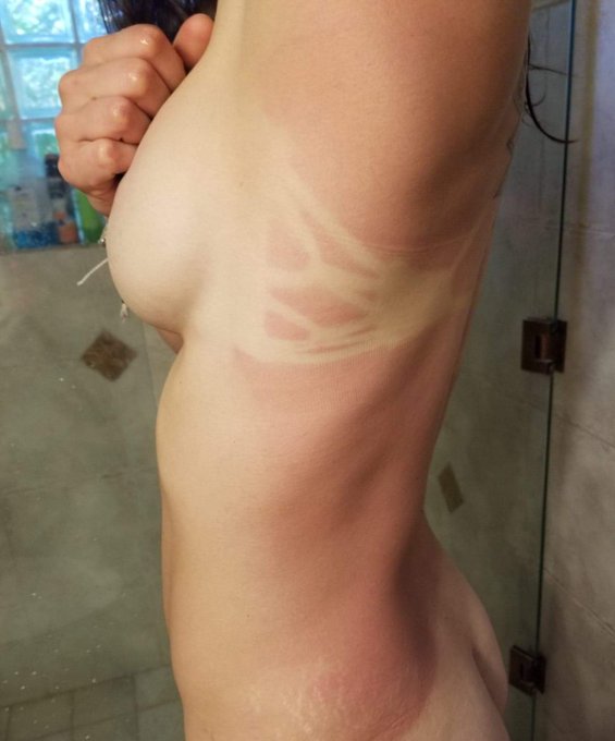 Got a bit of a burn.  Who's gunna rub some lotion on for me? https://t.co/xp3dkCSrDL