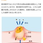 毒素によってニキビができるメカニズム!肝臓に負担がかかっている証拠かも？