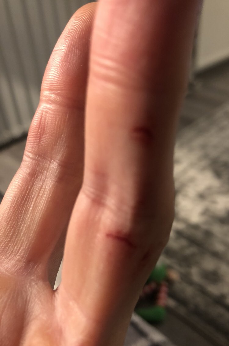 davidgbaird's tweet image. My Barbers course continues. War wounds from tonight. Didn’t lose a finger tho 🙄🤩. #Barber #Practice #noplasters 🤷‍♂️