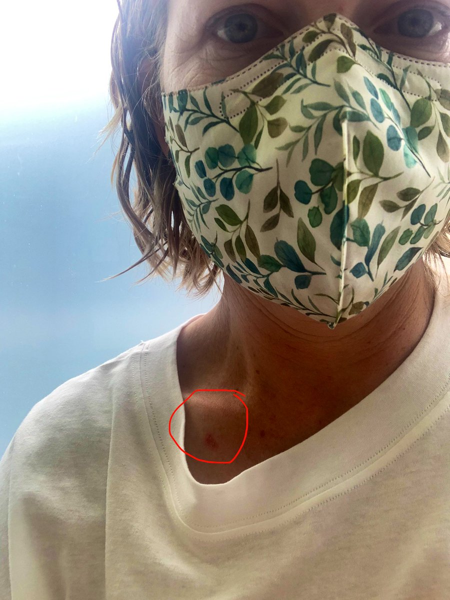 brongriffin's tweet photo. I relished in the freedom and adventure of the typical Aussie childhood. This distal parenting resulted in a lack of sunscreen, abundant sunburn and now >20 adult BCCs. As a burns clinical researcher I can’t help but wonder - apart from sun protection - what more can we do? https://t.co/mryd6RRmjZ