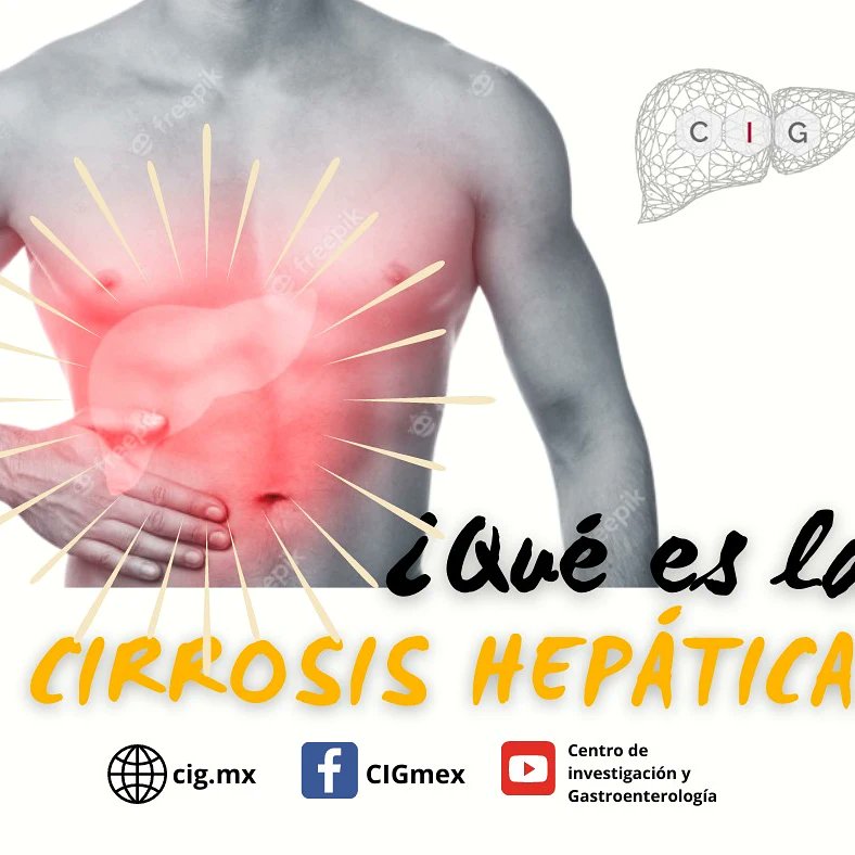 mexico_cig's tweet photo. La #CirrosisHepática es la etapa avanzada del cúmulo de fibrosis (F4), ocasionando un endurecimiento irreversible del hígado. Siendo la consecuencia de la adquisición de virus #Hepatitis B o C, #HígadoGraso, #ColangitisBiliarPrimaria, entre otras
#CIGMX #AmaTuHígado #CuidaTuSalud https://t.co/rQydITn77A