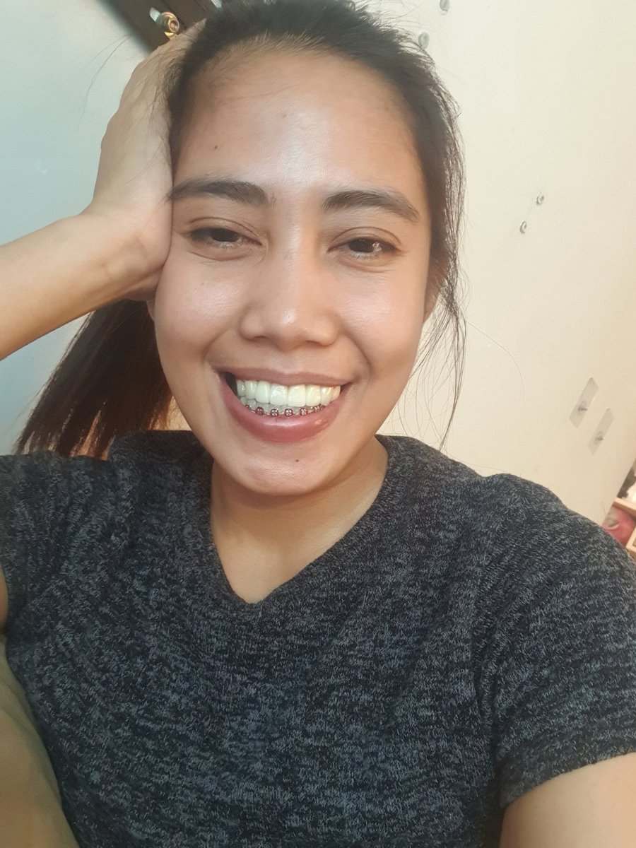 yanicaso's tweet photo. Yeeey.. dentist removed my upper braces na!
Cant wait for the lower one 😂 https://t.co/w7OqK1i2Dl
