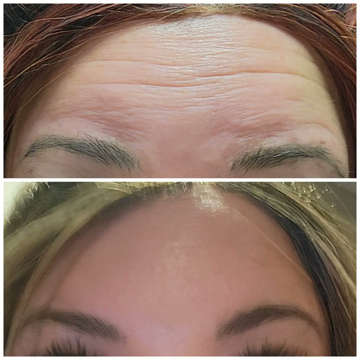 theamandaknight's tweet photo. #botoxbeforeandafter https://t.co/kOi1QIs0i9